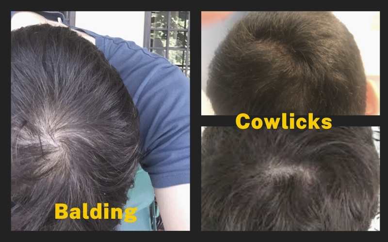 Cowlicks vs Balding