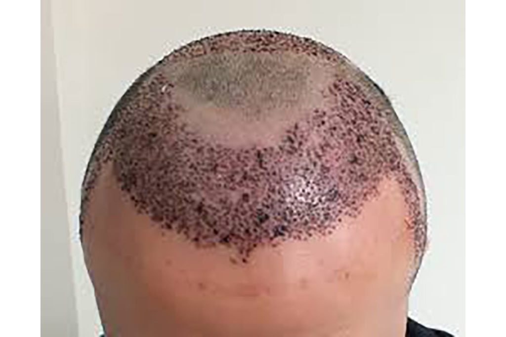 Hair Transplant Treatment