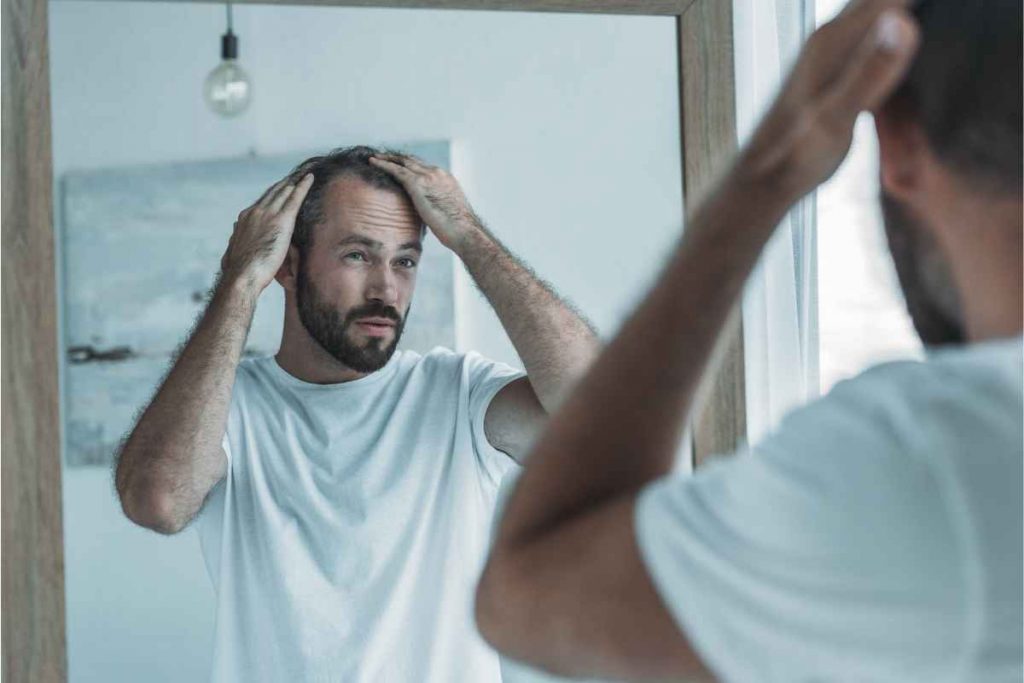 balding in your 20s hair loss male