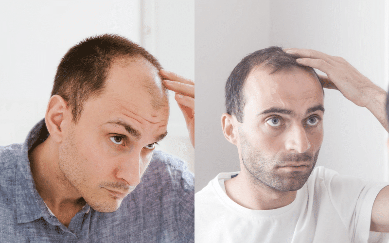 Hair Loss Denial - The Bald Company