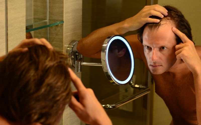 Signs of Hair Loss - Receding Hairline - The Bald Company