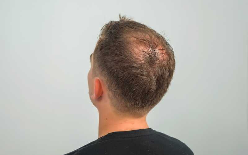 Signs of Hair Loss - Thinning of Crown - The Bald Company