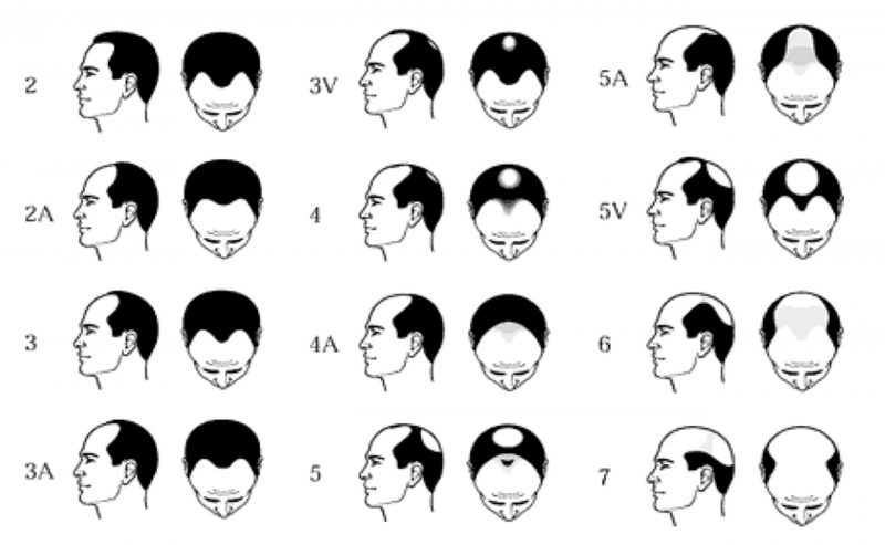 The Norwood Scale - The Bald Company