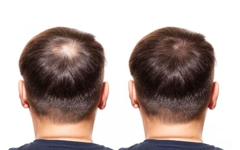 Cowlick Or Balding | Cowlick Hairline | The Bald Company