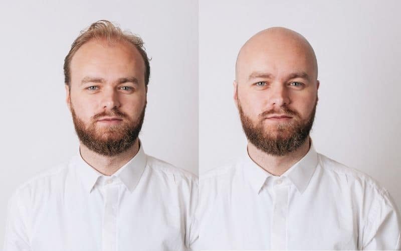 How To Tell If You're Going Bald The Bald Company