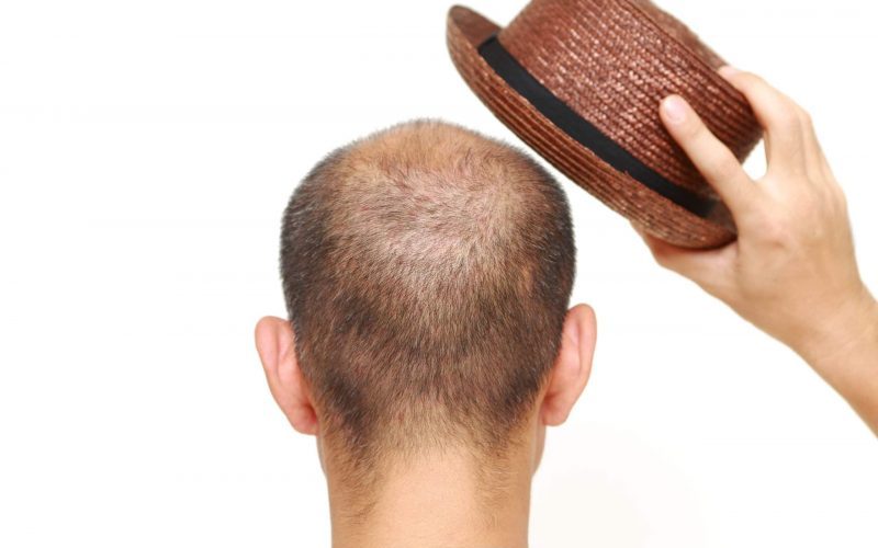 bald-man-hat-hair-loss-myths-bald-cause-baldness