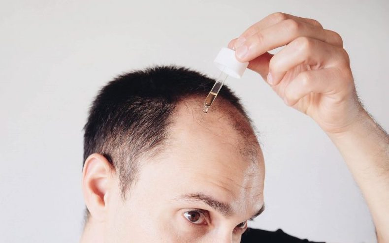 bald-man-hair-products-will-they-make-me-lose-my-hair-loss-causes