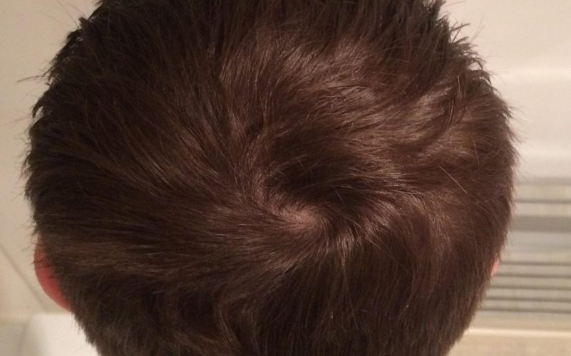 cowlick vs balding how to tell