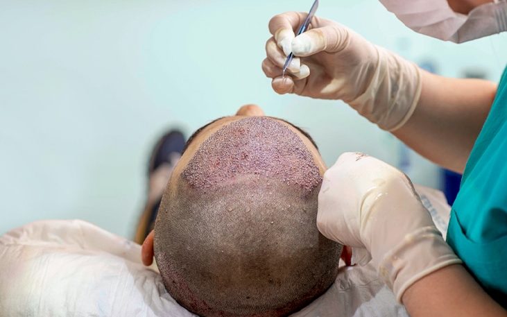 hair-transplant-cure-for-hair-loss-male-pattern-baldness-balding-myths