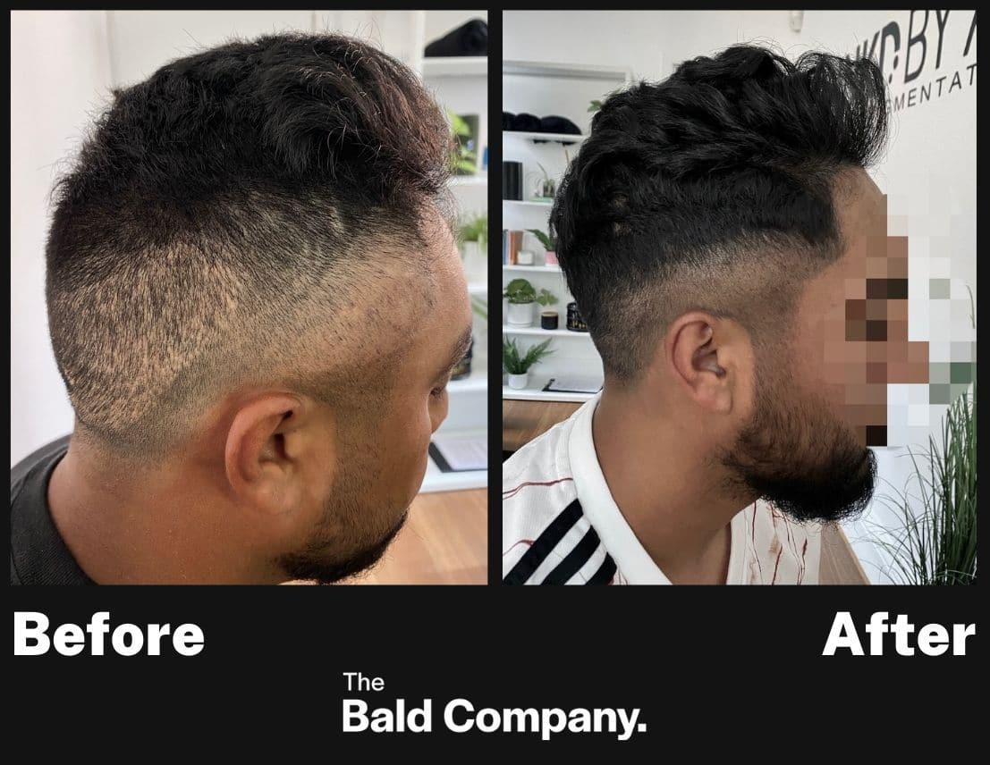 Before after scar coverage hair tattoo hair thinning INKD by AJ Melbourne