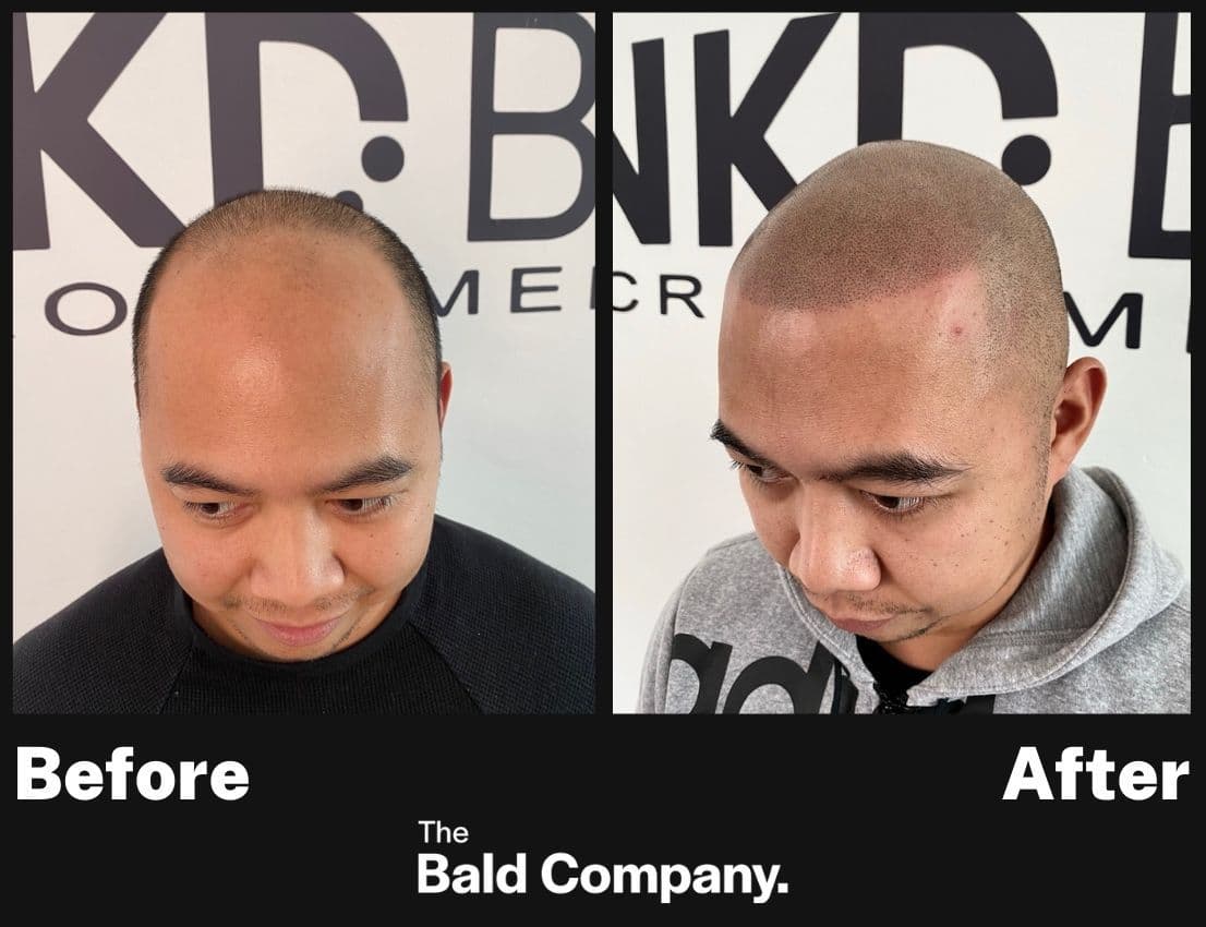 Latest Client Gallery - See Our Latest Scalp MicroPigmentation Clients