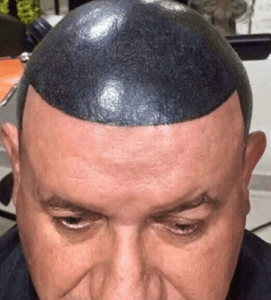 Fake hair tattoo goes wrong as cancer survivor is left with bright blue head   Metro News