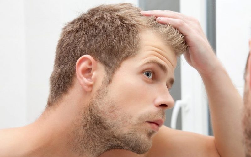 balding in your 20s as a male