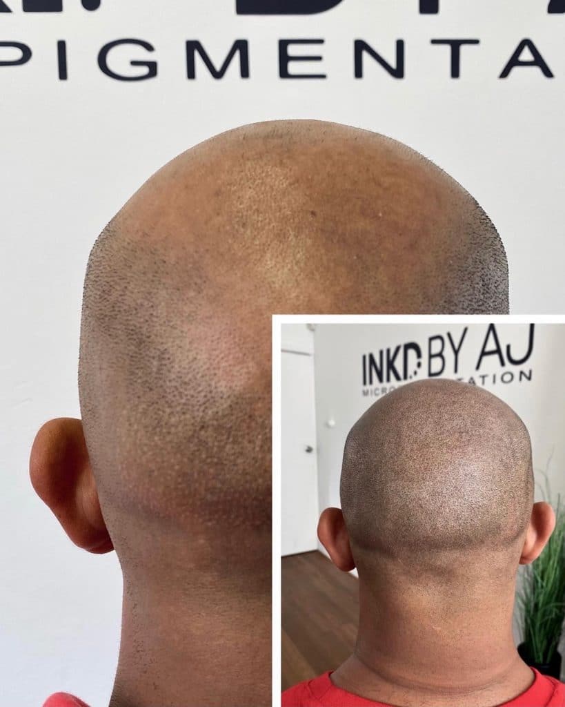 before and after comparison scalp micro-pigmentation