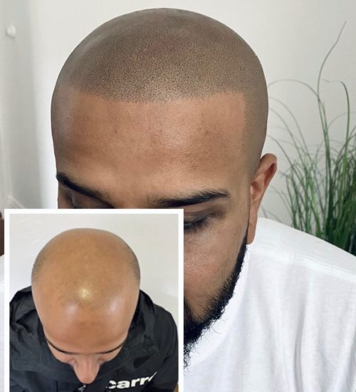 Scalp Micropigmentation Hair Tattoos Give Balding Men New Hair Hope