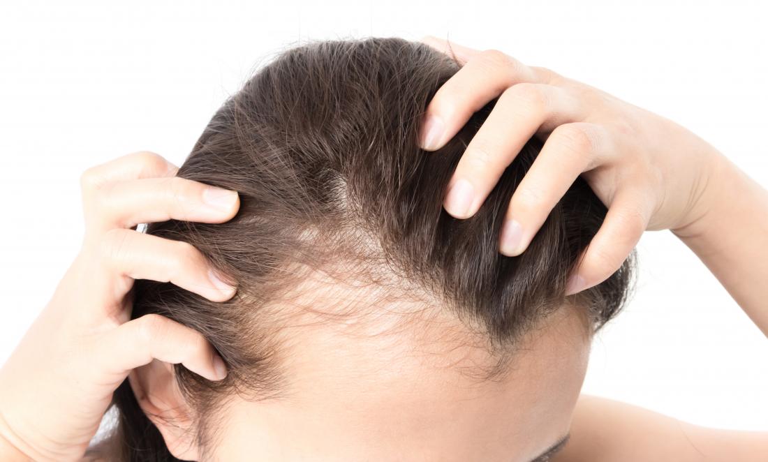 postpartum-hair-loss-telogen-effluvium