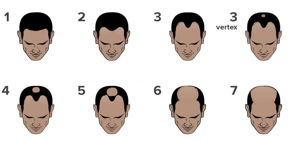 Norwood Chart Pattern Baldness