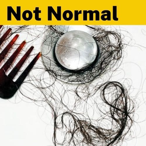 What Is a Normal Amount of Hair Loss to From Showering?