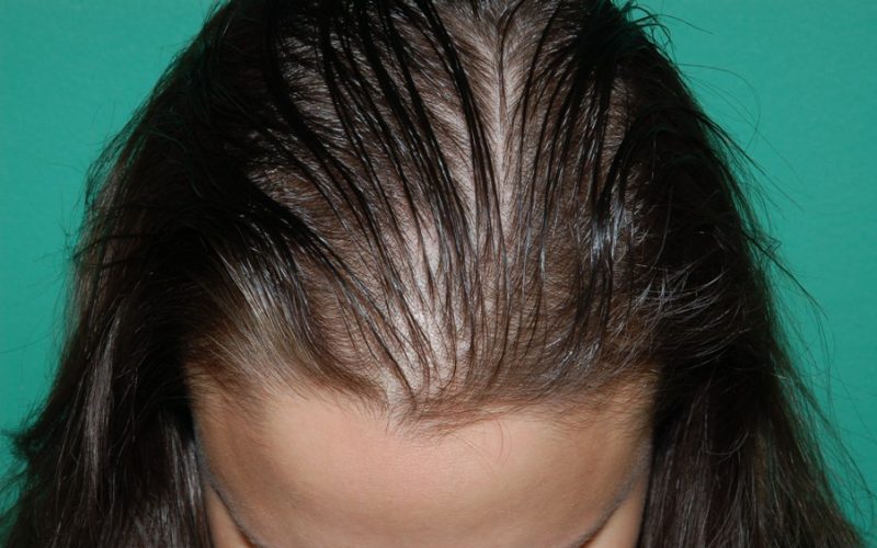 female pattern baldness