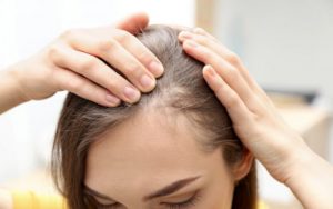 what causes female pattern baldness